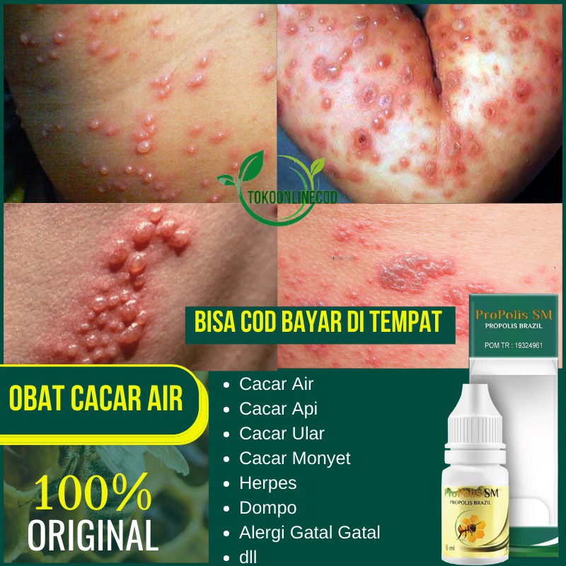 Obat alami cacar air untuk anak 2 tahun, di apotik. Obat Cacar Air Cacar Api Cacar Ular Herpes Dompo Penyakit Kulit Alami Menahun Propolis Sm Shopee Indonesia