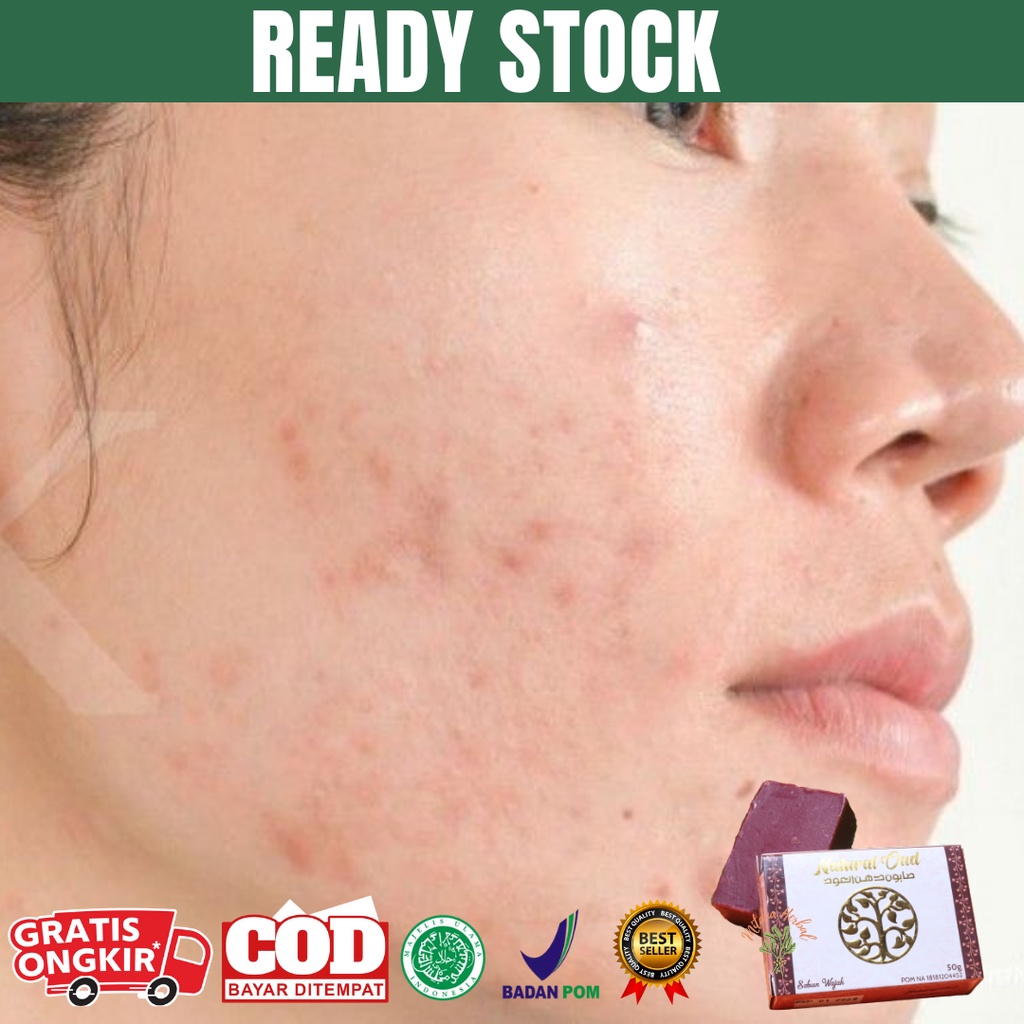 Begini cara cepat menghilangkan jerawat dengan es batu. Harga Cara Menghilangkan Flek Hitam Jerawat Terbaru November 2021 Biggo Indonesia