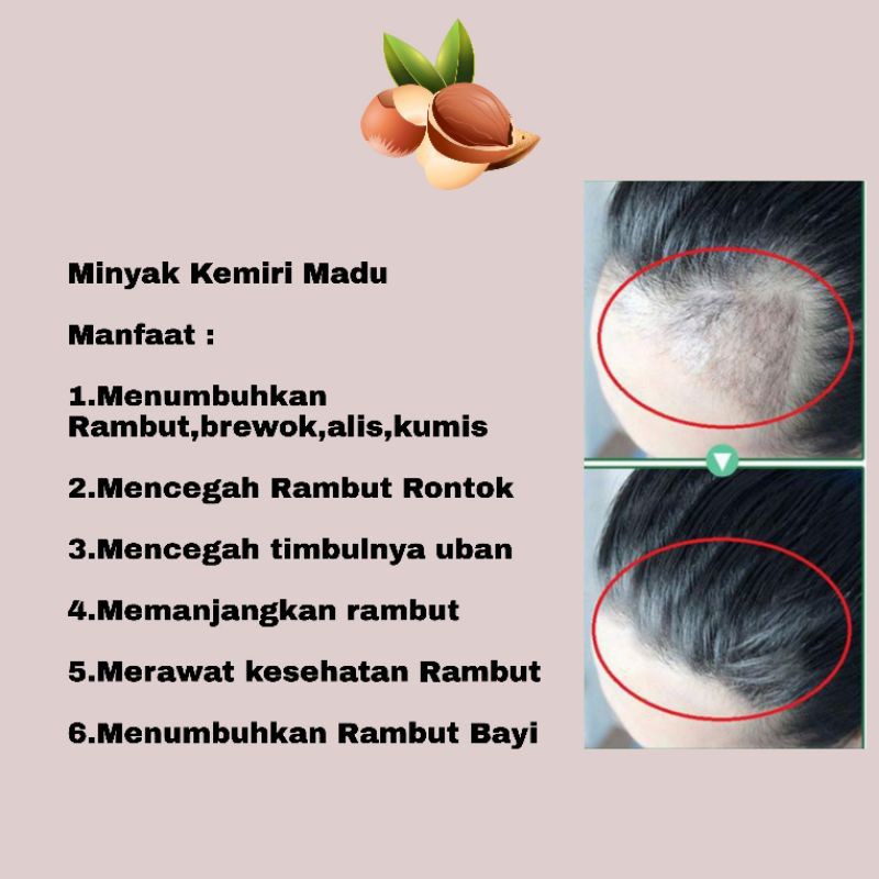 Mengaplikasikan madu ke rambut dapat mempercepat proses penyembuhan rambut dari kerusakan serta melindungi rambut dari kerusakan akibat faktor . Jual Penumbuh Rambut Rontok Atasi Kebotakan Penyubur Rambut Penghilang Uban Dan Ketombe Minyak Kemiri Kamila Premium Solusi Tepat Perawatan Rambut Terbaik Indonesia Shopee Indonesia