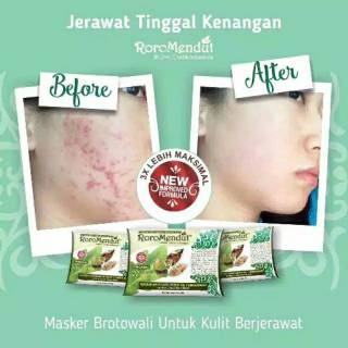 Setelah pemakaian memang ada efek mencerahkannya, cuma karena dia . Jual Mini Size 20gr Masker Jerawat Roro Mendut Brotowali Original Bpom Indonesia Shopee Indonesia