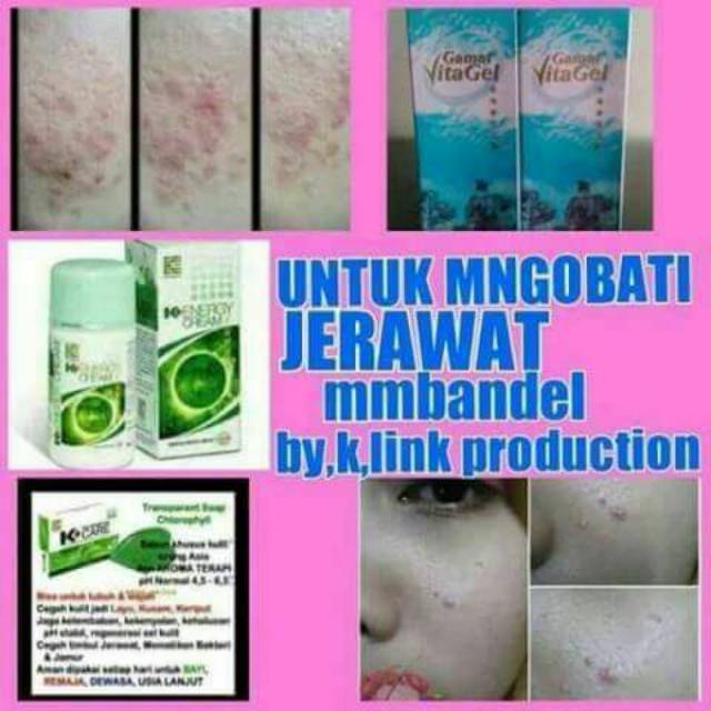 Beli ayuderme k link | ayuderma rawatan kulit | obat jerawat ampuh | ayuderme ayurveda original k link terbaru di shopee. Jual Gamat Vitagel K Link Gel Penghilang Jerawat Luka Bakar Indonesia Shopee Indonesia