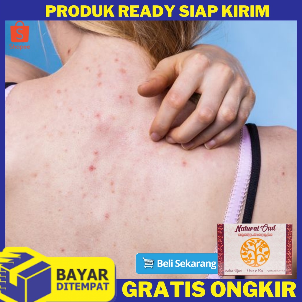 Belanja online obat jerawat punggung dada terbaik, terlengkap & harga termurah di lazada indonesia | bisa cod ✓ gratis ongkir ✓ voucher diskon. Harga Obat Jerawat Punggung Dan Dada Terbaru November 2021 Biggo Indonesia