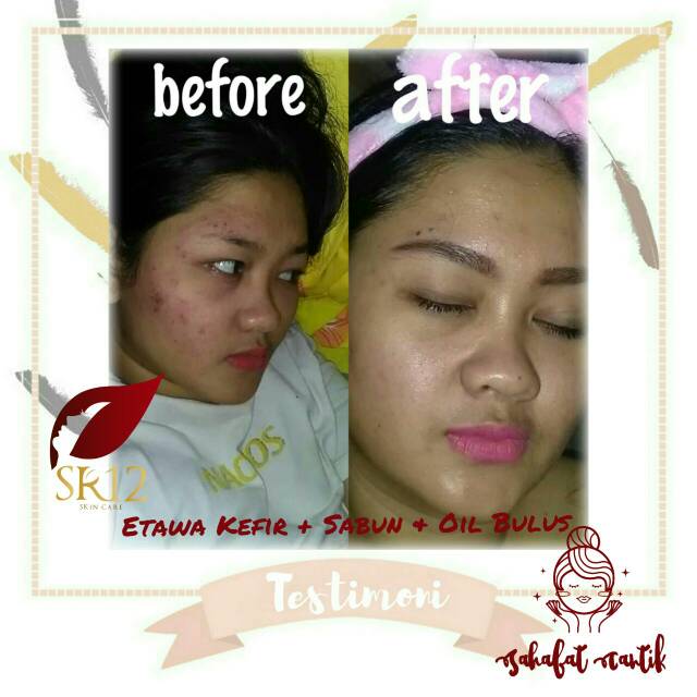 Oleskan masker merata dengan kuas atau langsung dengan tangan yang . Masker Kefir Etawa Sr12 Masker Alami Masker Herbal Masker Susu Kambing Etawa Masker Jerawat Shopee Indonesia