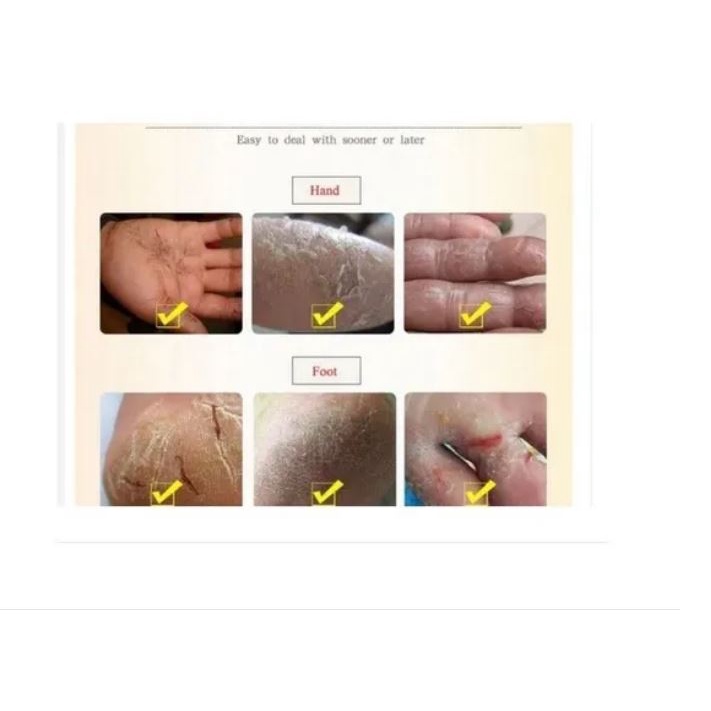 Muitas pessoas confundem qualquer tipo de calo com o conhecido “olho de peixe”, que surge na planta do pé e é uma verruga plantar. Creme Para Remover Calos Dos Pes Ressecamento Remove Pele Grossa Olho De Peixe Dos Pes E Maos E Rachaduras Shopee Brasil