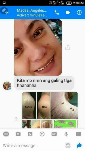 * privasi di jamin % aman., * no . Big Sale Kasoy Oil Onhand Warts Mole Skintags Remover Shopee Philippines
