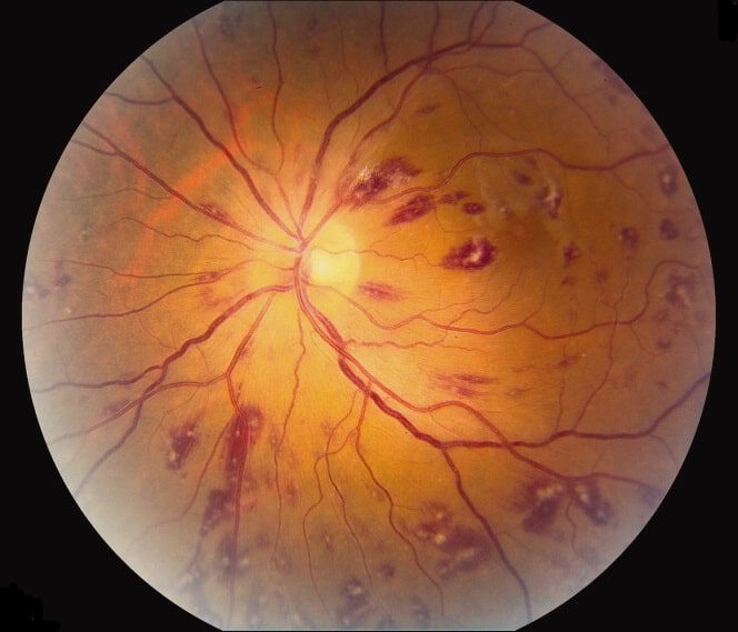 We all have blind spots. Roth Spots, Case presentation, causes, examination and