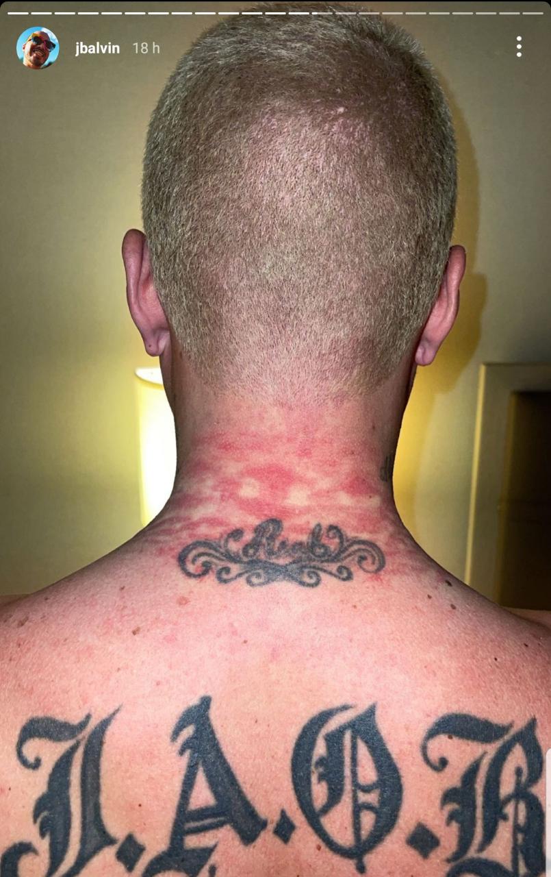 Así Le Quedó El Cuello A J Balvin Luego De 'Cargar Con El Peso De Sus Cadenas' En La Met Gala - Infobae 1280_x_805_jpg