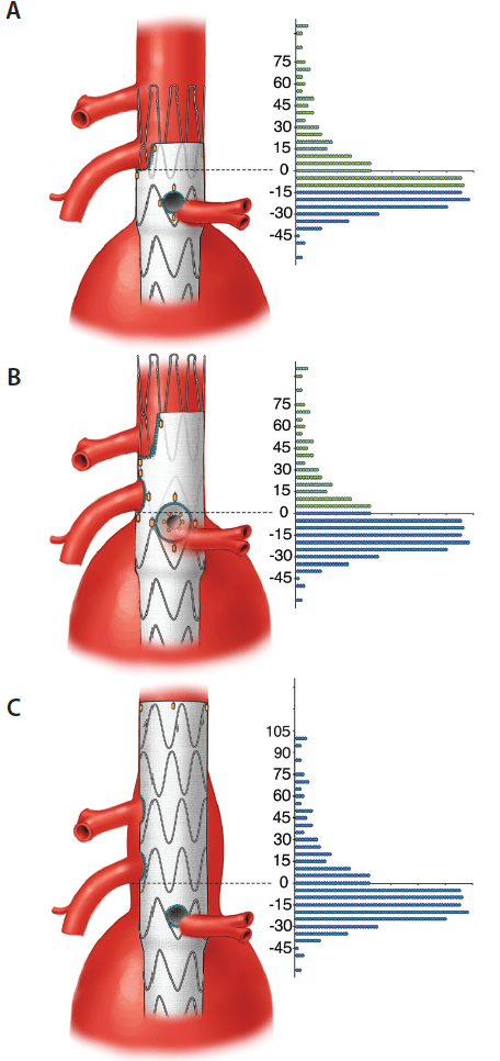 Modern Complex Stent Graft Designs A Closer Look Endovascular Today