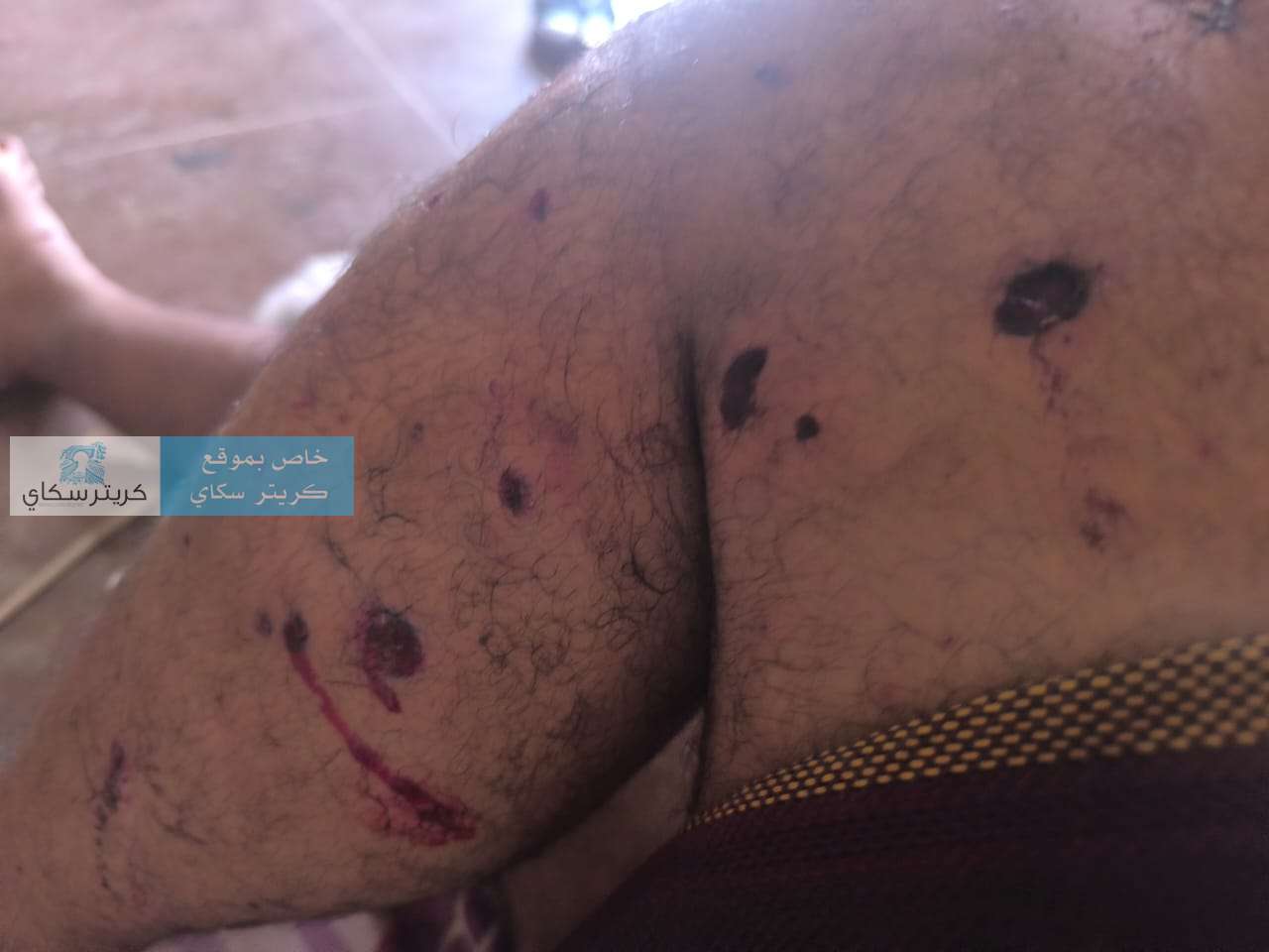 مواطن يروي تفاصيل تعرضه لإطلاق نار وقنبلة في واقعة مسلحة بعدن