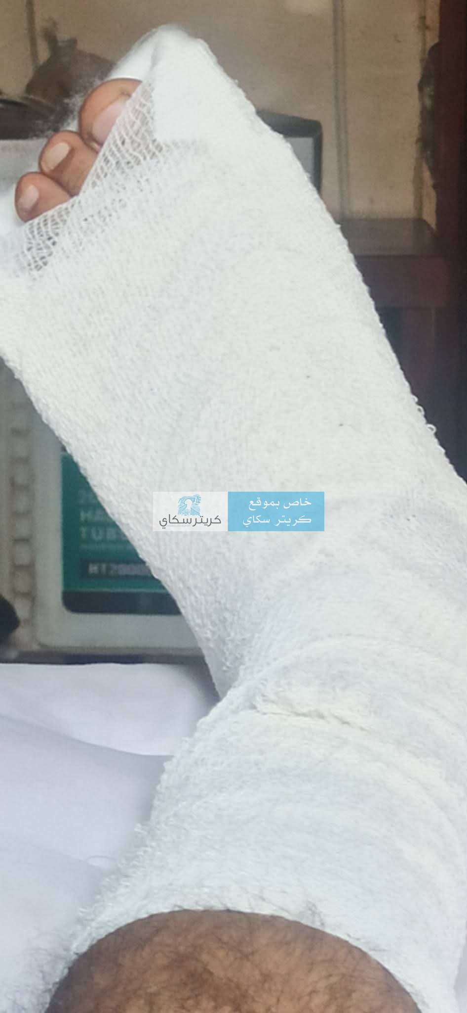 كلاب ضالة تقتحم منزلاً وتتسبب بكسر مواطن في عدن.. ومناشدة عاجلة للمحافظ
