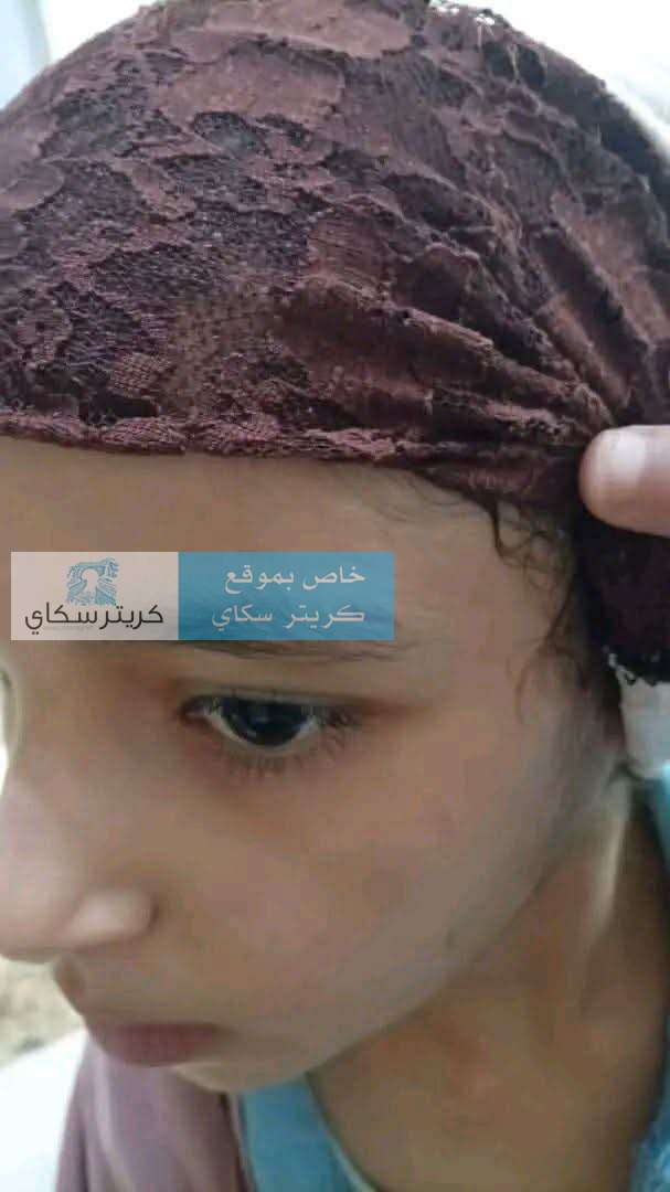 جر يمة مروعة.. تعرض طفلة لتعذيب قاسٍ على يد زوجة أبيها