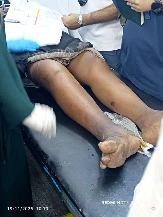 مريض مهدد ببتر ساقه ودعوات لإنقاذه
