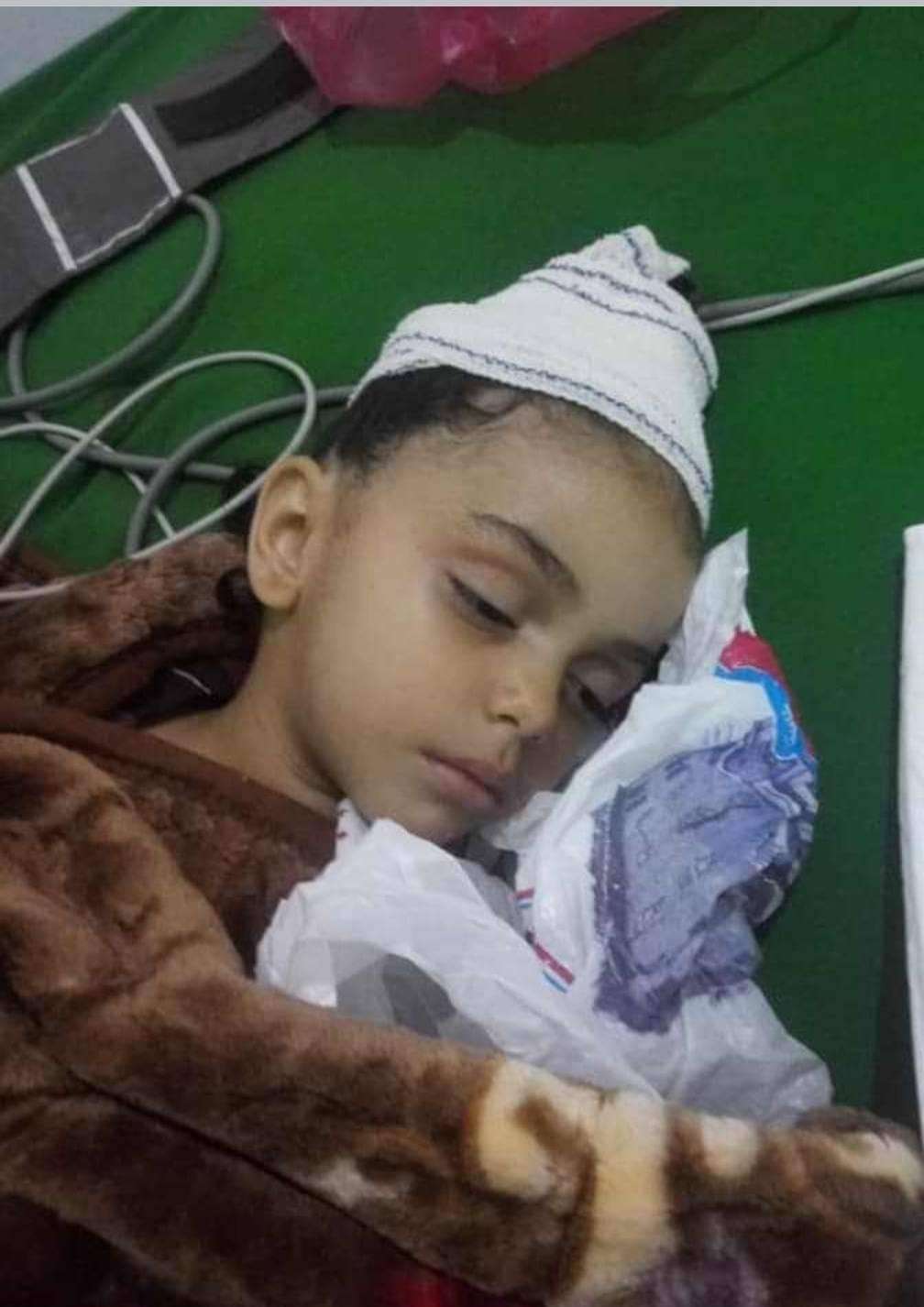 صورة وحدث.. إستخراج رصاصة راجع من جسد طفلة في إب صورة وحدث.. إستخراج رصاصة راجع من جسد طفلة في إب