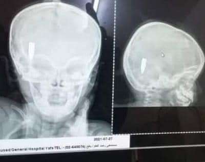 عقب عملية ناجحة .. تحسن حالة الطفلة المصابة برصاص راجع في يافع