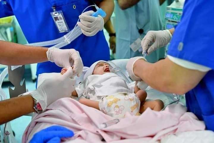 بالصور .. السعودية تعلن نجاح عملية فصل التوأم الطفيلي اليمني