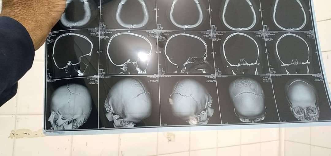 مدير المستشفى المركزي بالمهرة يبارك نجاح عملية جراحية معقدة في الدماغ بمستشفى الغيضة