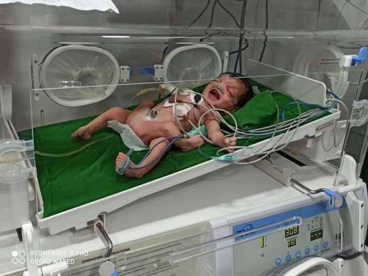 بالصورة .. ولادة طفل بحالة نادرة في حضرموت