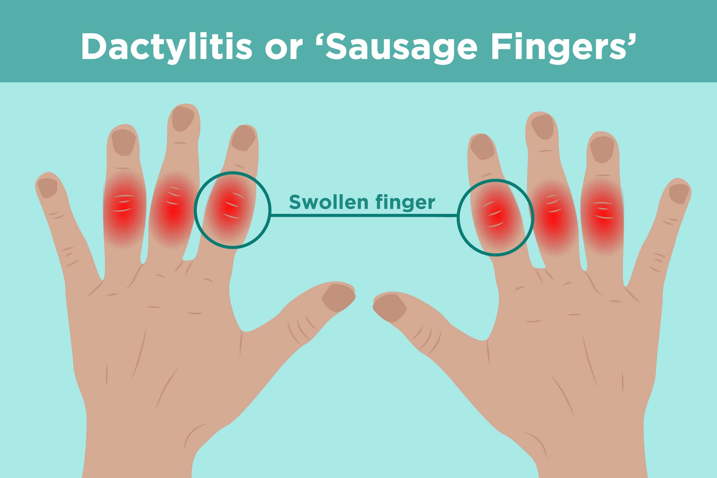 View Burning Sensation In Knuckles Pictures