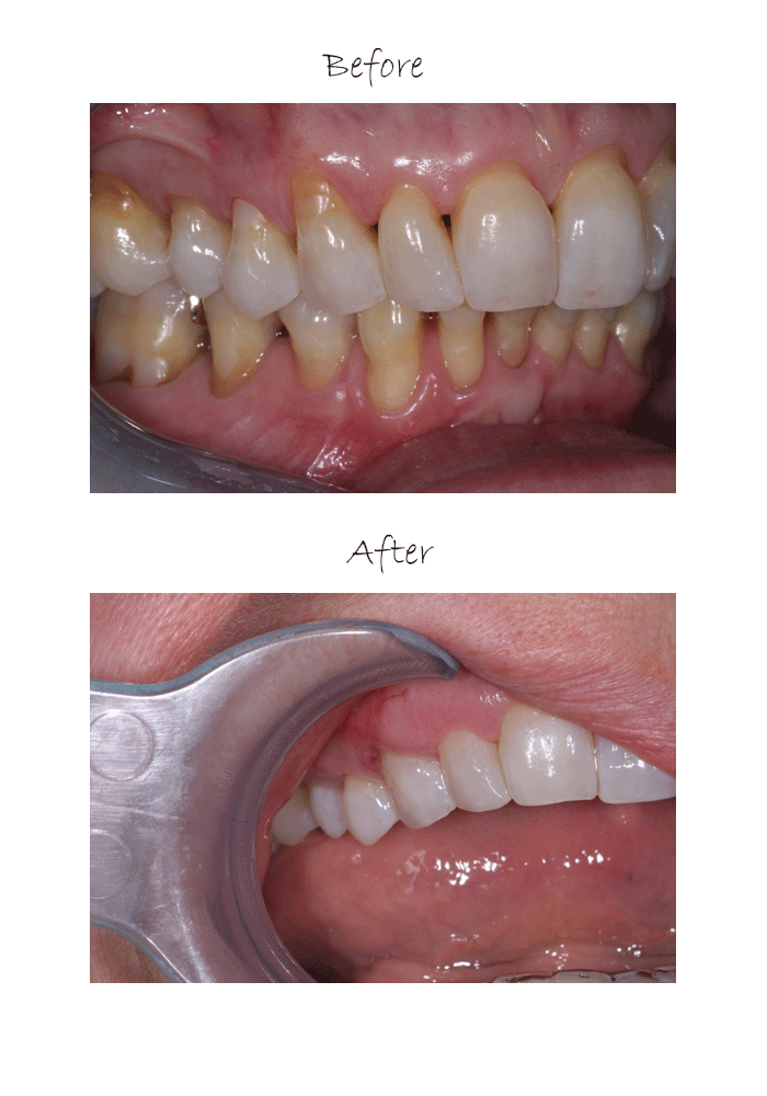 Pinhole Surgical Technique CreateSmiles by Dr. Brad