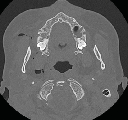 Managing Subcutaneous Emphysema Following Dental Procedures Decisions