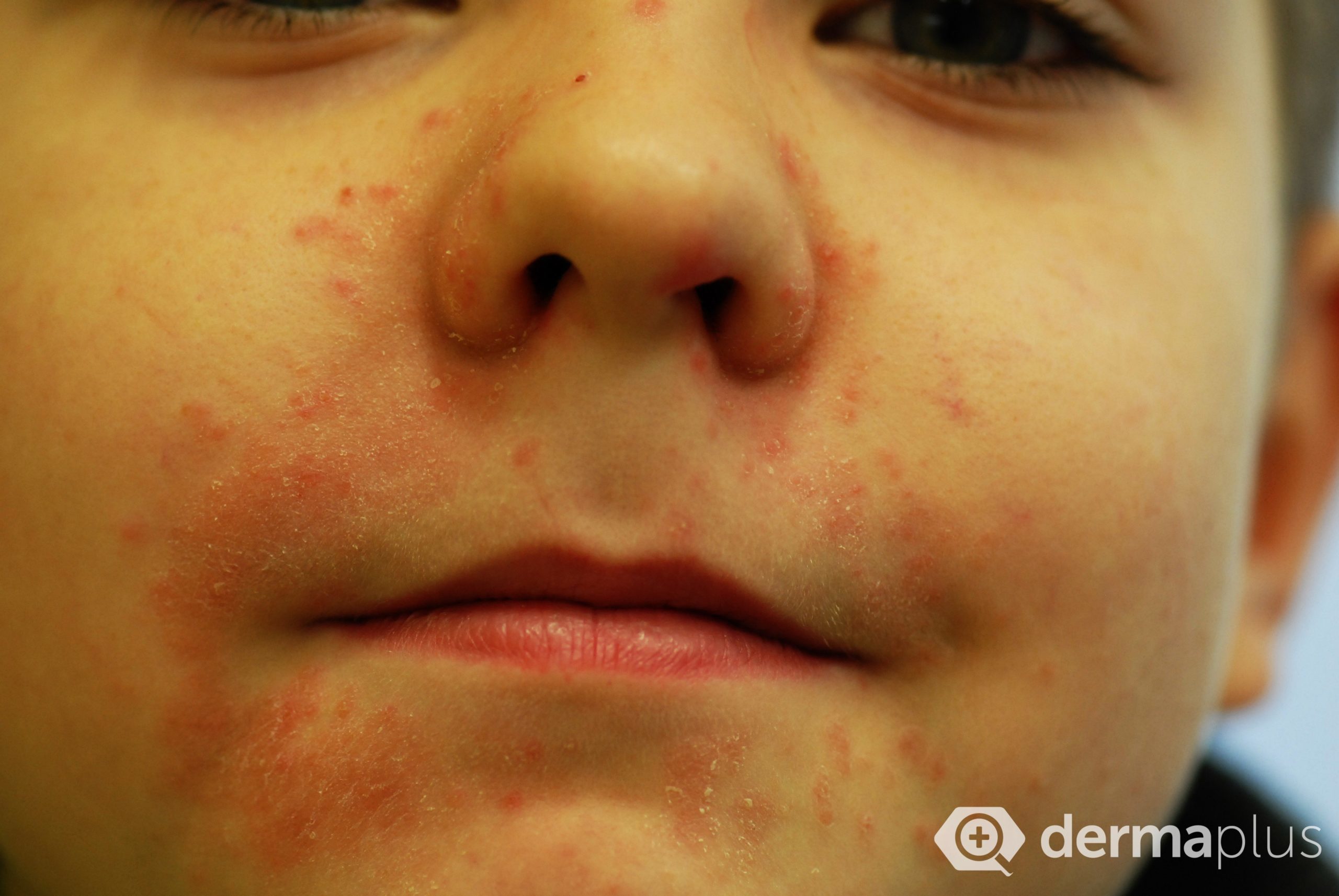 Selbstverletzendes verhalten (svv), bei dem sich betroffene bewusst selbst verletzen (z.b. Mundrose Periorale Dermatitis Ursachen Therapie Derma Plus