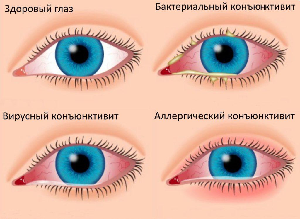 Почему у ребенка гноится глаз со специфическим. Гной в глазах у ребенка