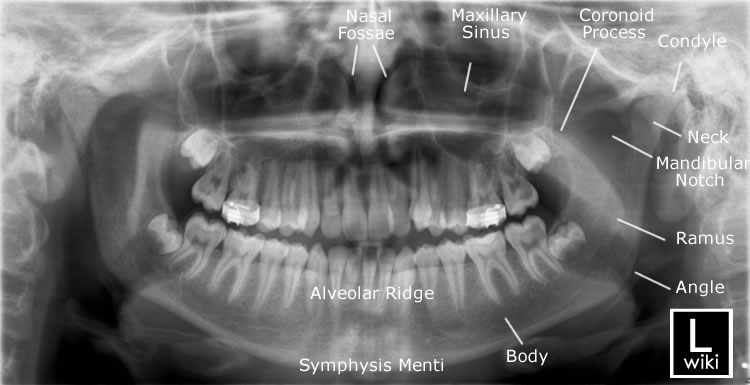 Mandible x-rays