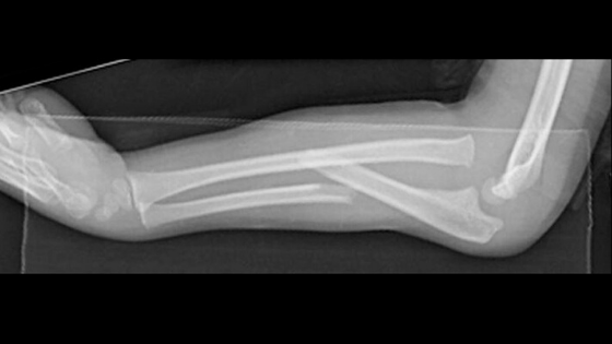 Monteggia Fracture Dislocations