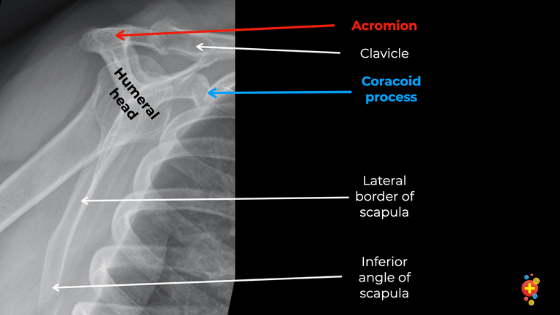 Shoulder X Ray Interpretation Don T Forget The Bubbles