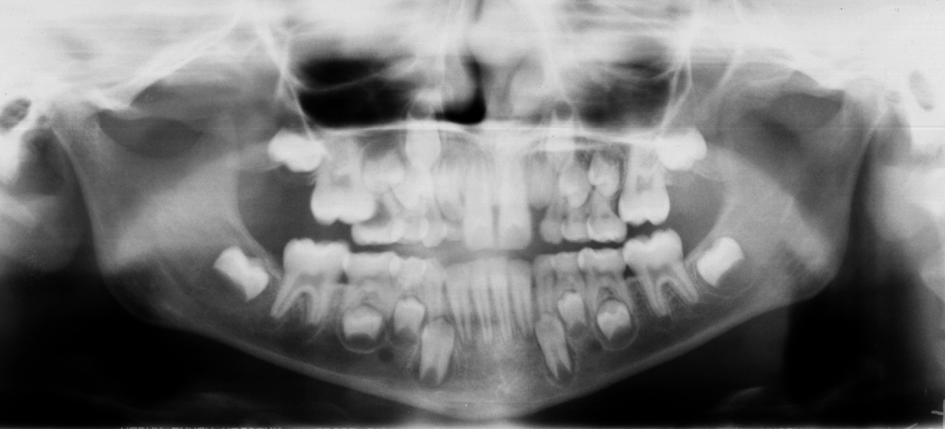 Ectopic Eruption Dr G s Toothpix