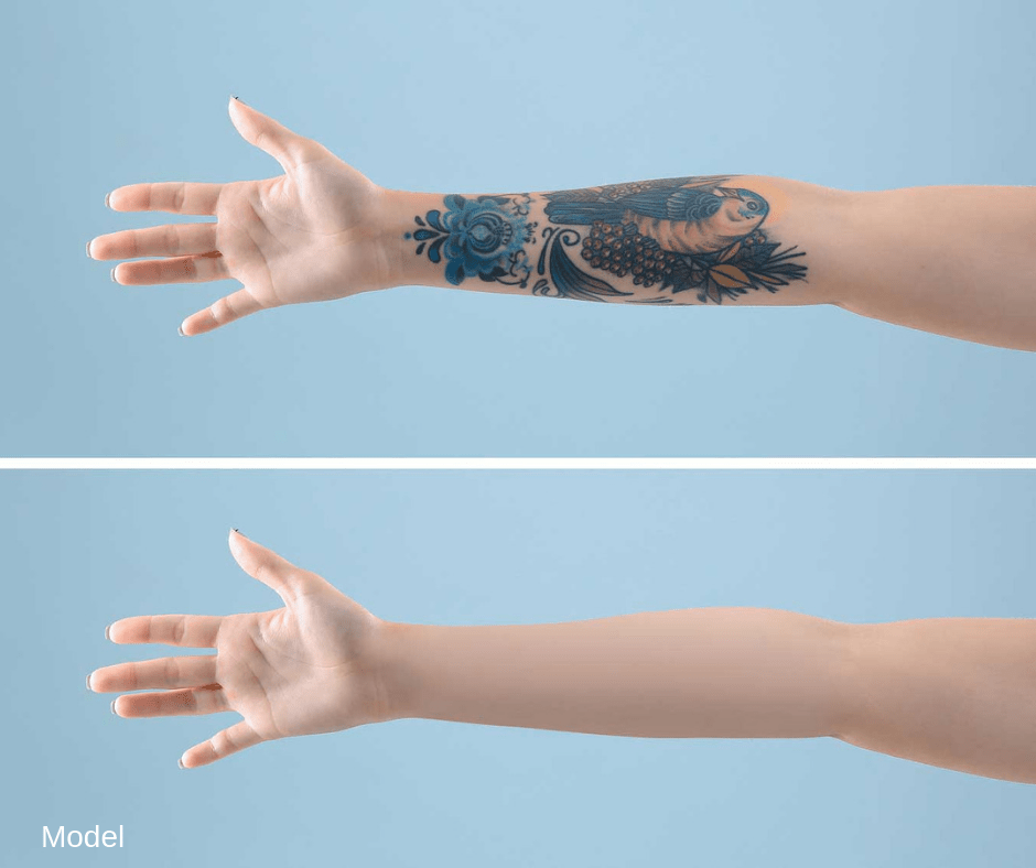Laser Tattoo Removal: Step-By-Step | Dr. Jerome Potozkin 788_x_940_png