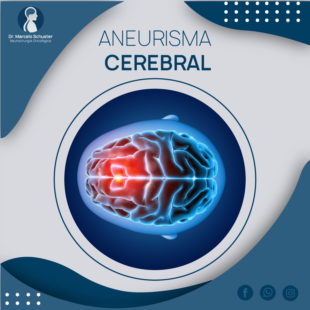 Uma comparação de como se parece um aneurisma é a dilatação ou irregularidade da câmara de um pneu. Aneurisma Cerebral Dr Marcelo Schuster
