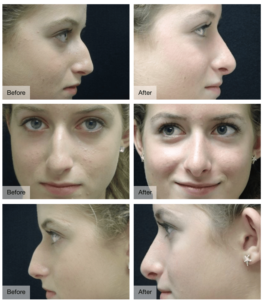 What is dysport and how does it work? Rhinoplasty Nose Job Procedure In Oklahoma City Dr Tim Love