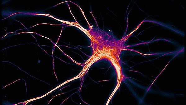 Neurodegenerative diseases affect millions of people worldwide and occur when nerve cells in the brain or peripheral nervous system lose function over time and ultimately die. How Alzheimer S Disease Spreads Through The B Eurekalert