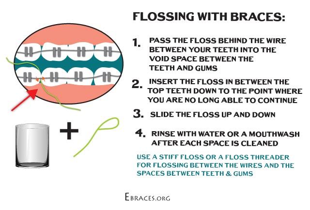 We may earn commission on some of the items you choose to buy. How to Floss with Braces and Help Your Teeth Look Better