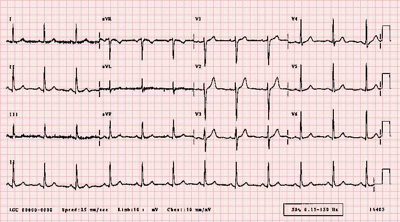 This electrical activity generated by the heart can be measured by an array of electrodes placed on the body surface. Ecglibrary Com