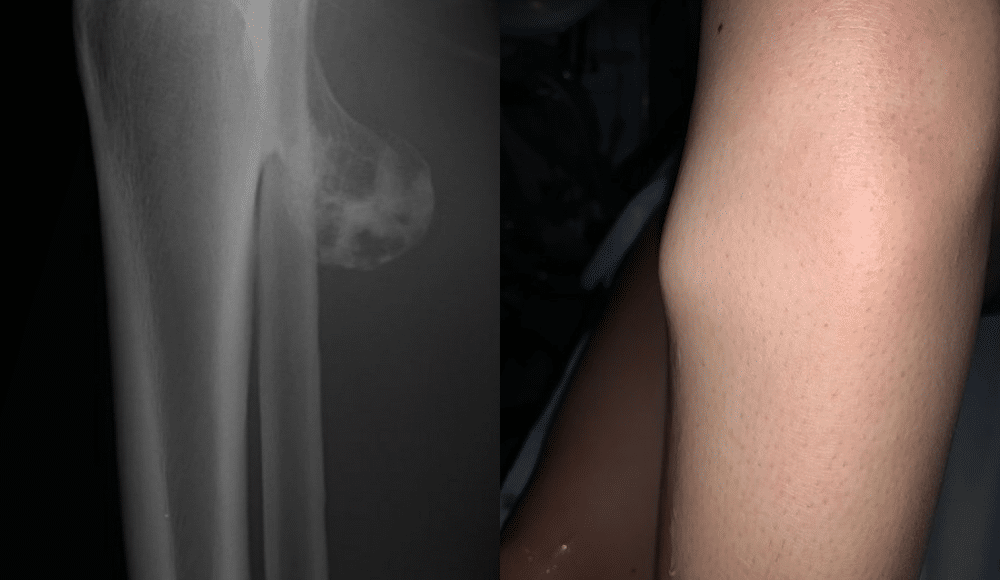 Osteocondroma em Raio-X (imagem: Shutterstock) e em paciente (arquivo Cetrus)