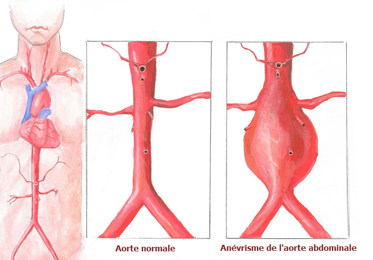 Anévrisme De L Aorte Esperance De Vie