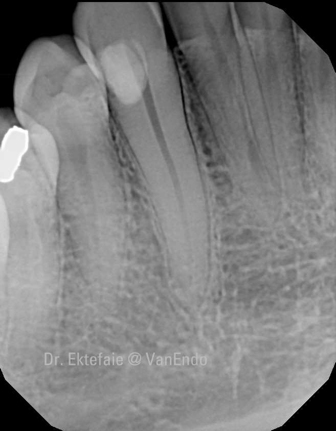 post-op radiograph