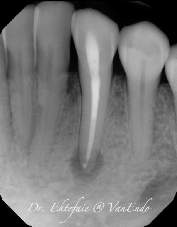 Post-op radiograph of tooth #3-3