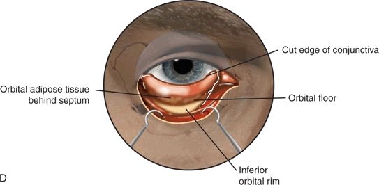 Transorbital Endoscopic Approaches to the Middle Cranial Fossa | Ento Key