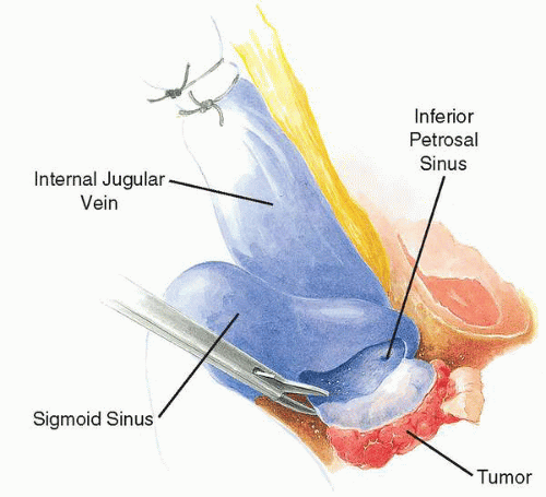 Paragangliomas of the Temporal Bone | Ento Key