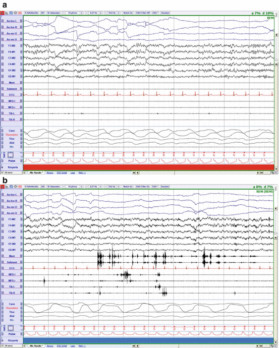 Quality Control for Diagnosis of REM Sleep Behavior Disorder Criteria