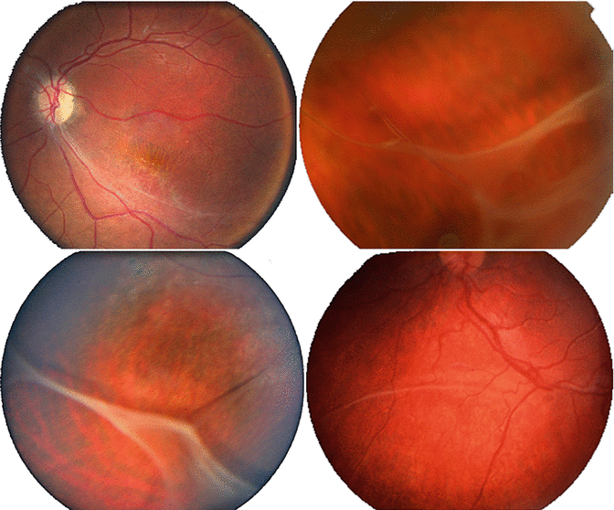 XLinked Retinoschisis Ento Key