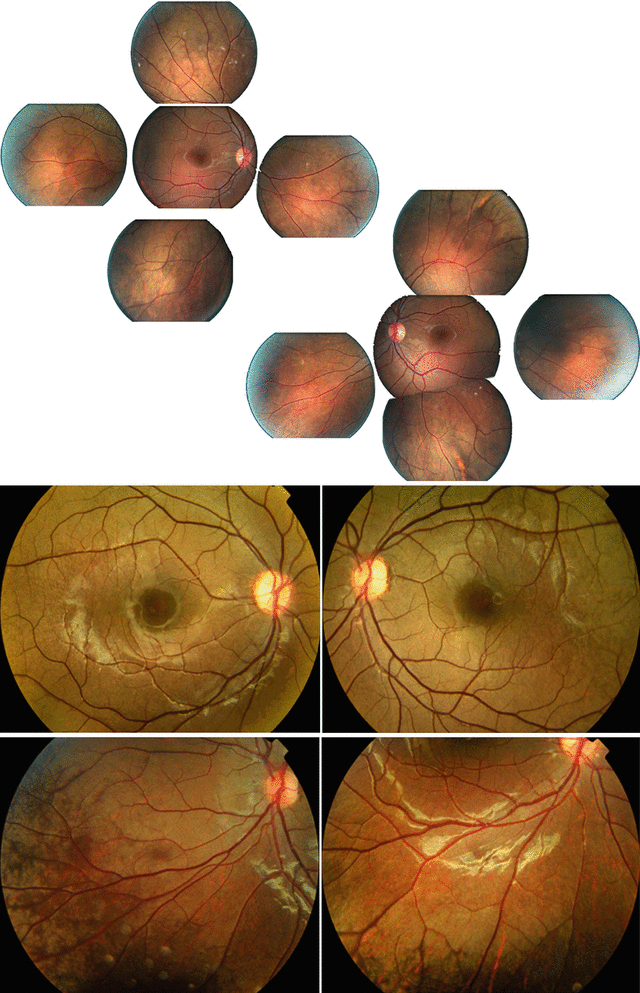XLinked Retinoschisis Ento Key