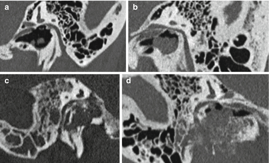 Imaging of Jugular Paragangliomas | Ento Key