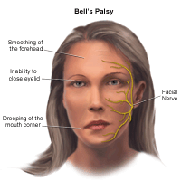 The diagnosis is made when no other cause can be . Tmj Bell S Palsy Emergency Dentist Boca Raton