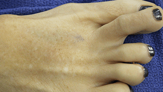 Aug 14, 2019 · facet joints have a nerve supply from two levels, one branch arises from the nerve root at that level and the second from the level above. Capsulitis Of The Second Toe Feetfixer