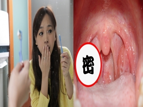 扁桃腺結石棉花棒 口臭都去除不掉 那是因為你嘴巴裡面長了ooo的緣故 天呀 真是太 藥師