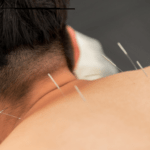 Acupuncture